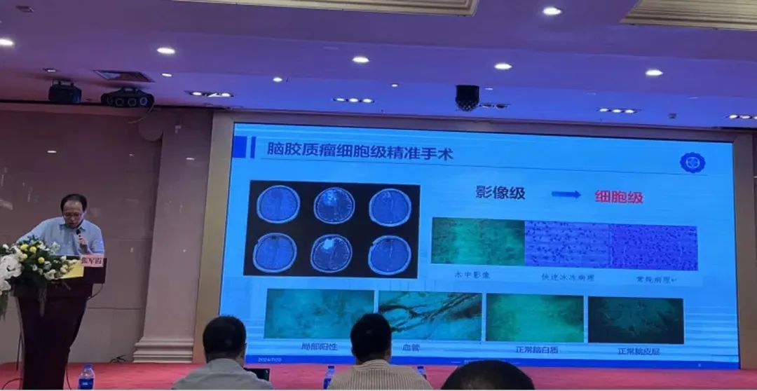 術(shù)中手持顯微鏡EndoSCell?助推腦膠質(zhì)瘤診療進(jìn)入細(xì)胞級(jí)精準(zhǔn)手術(shù)時(shí)代(圖5)