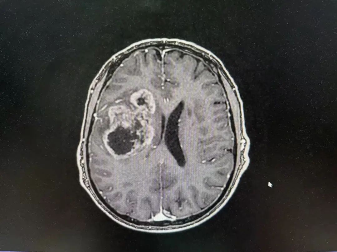 河北醫(yī)大二院應(yīng)用細胞級熒光導(dǎo)引精準技術(shù)，突破高級別膠質(zhì)瘤手術(shù)的裸眼限制(圖4)