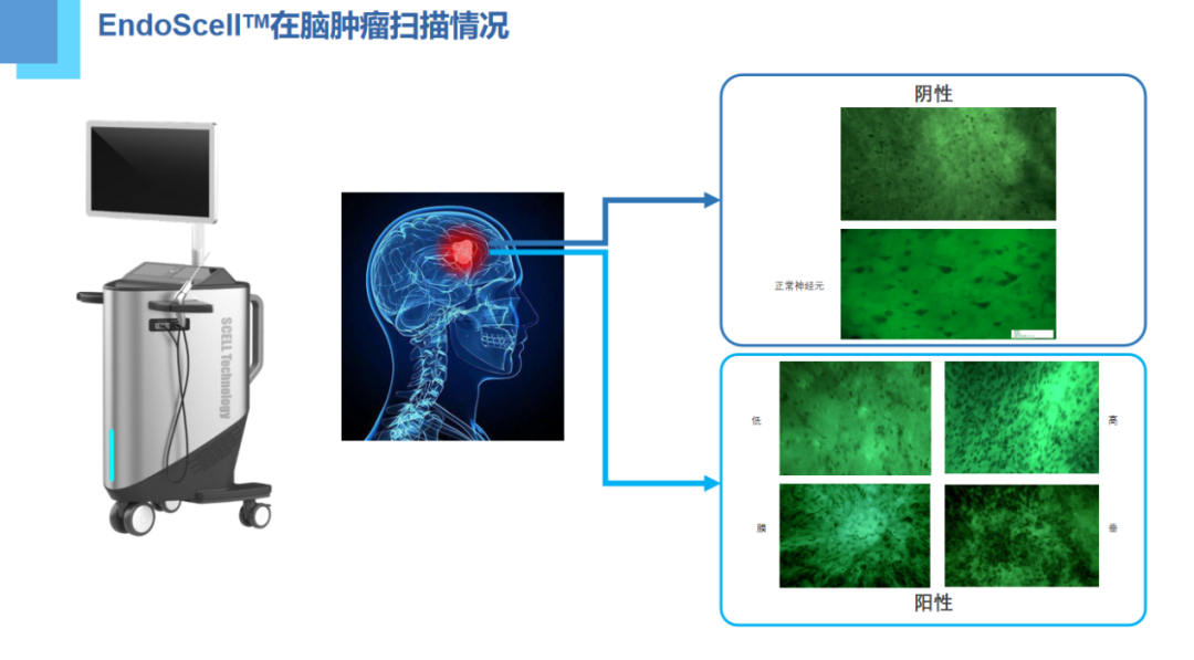 河北神經(jīng)腫瘤盛會(huì)：專家點(diǎn)贊EndoSCell?術(shù)中細(xì)胞級(jí)熒光導(dǎo)引技術(shù)(圖10)
