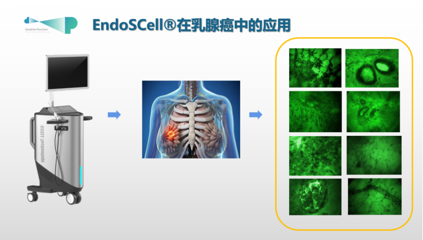 天津國際乳腺癌大會專家銳評：EndoSCell?細(xì)胞級精準(zhǔn)手術(shù)有助提高保乳率(圖3)